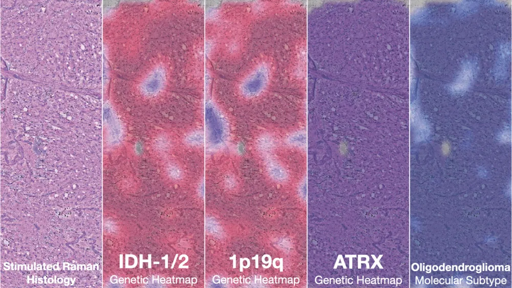 Figure from Artificial-intelligence-based molecular classification of diffuse gliomas using rapid, label-free optical imaging
